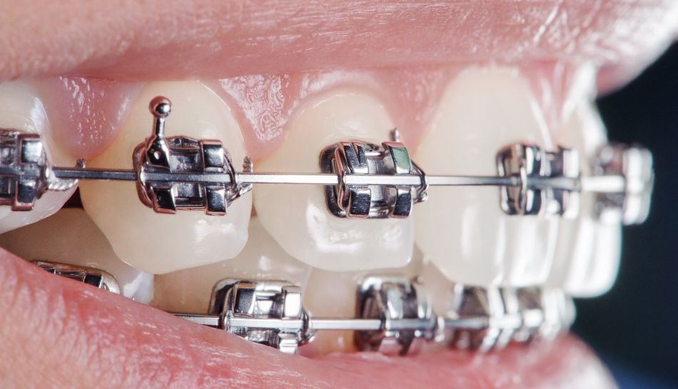 brackets-metalicos